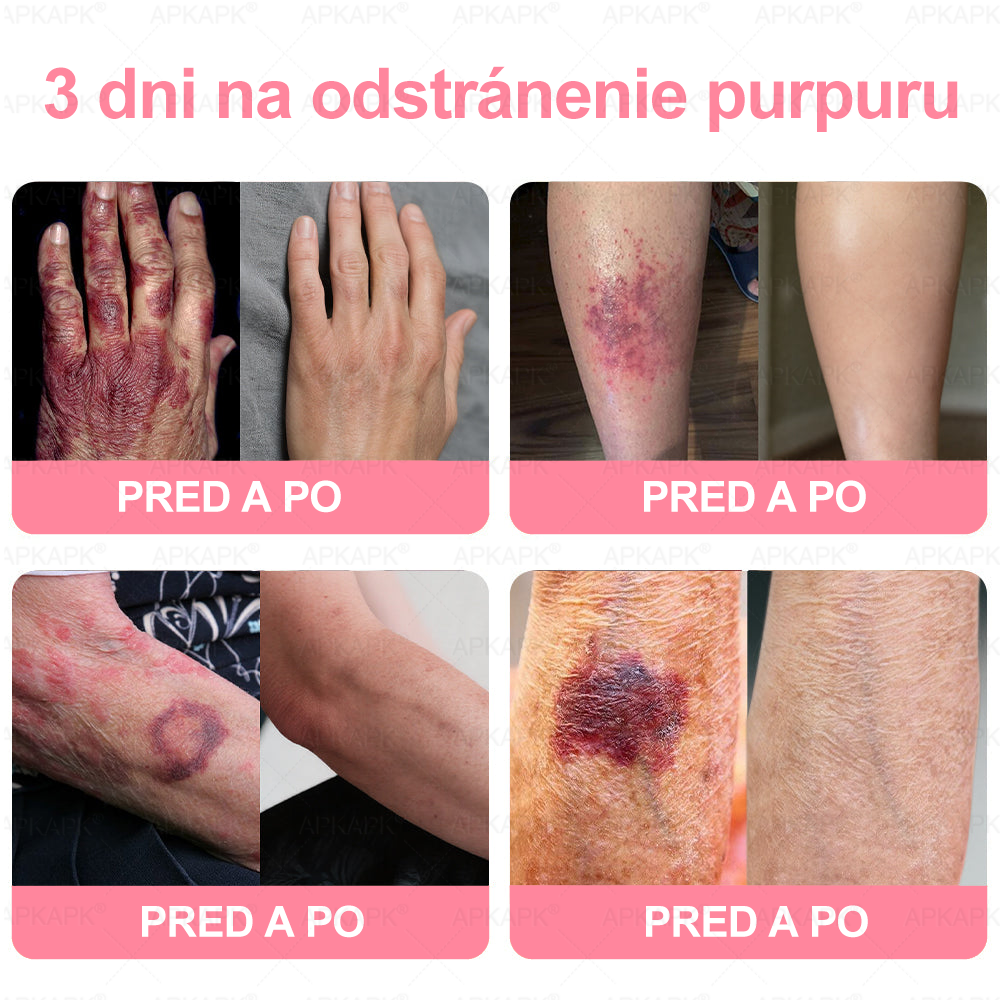 👨⚕️ Vyrobené a zaslané zo Slovenska ✨ APKAPK® 99% PDRN lososový DNA anti-aging ampulový roztok s 99% PDRN + včelí jed · 7x hlboká hydratácia | Rieši vrásky, suchosť, začervenanie, tmavé škvrny, purpuru a zápal — Viditeľné výsledky za 7 dní
